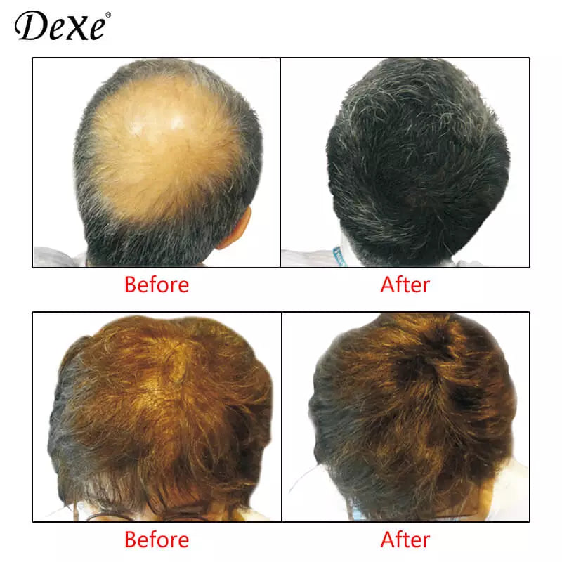 Dexe Hair Building Fiber Black 22gm - Instant Hair Thickening Solution